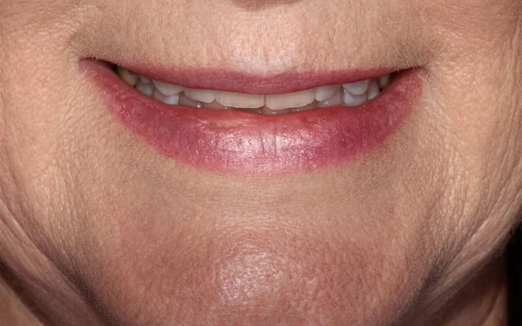 zoom teeth whitening houston zoom teeth whitening houston