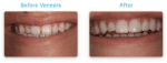 Dental Veneer Before & Afters