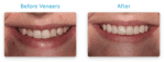 Dental Veneer Before & Afters