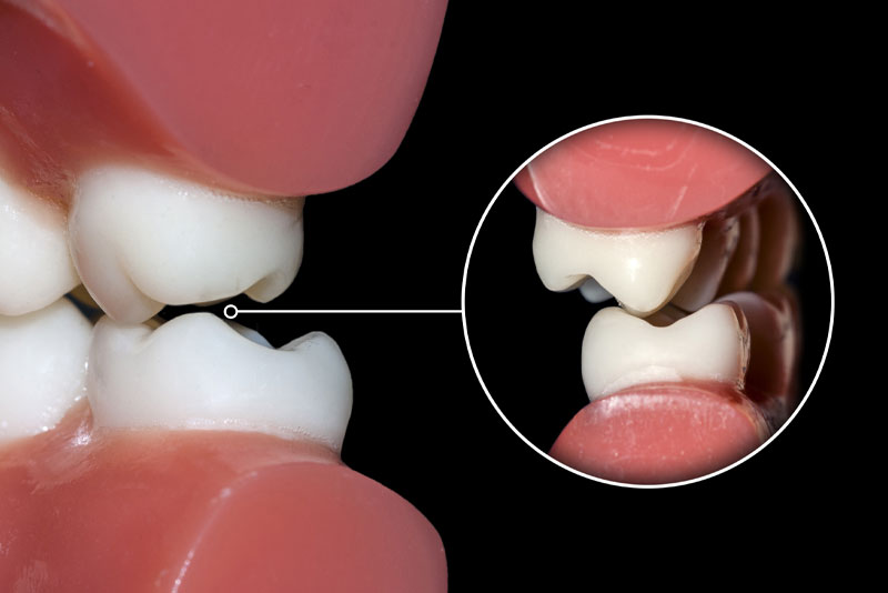 Will I Be Able To Get My Bruxism Treated?