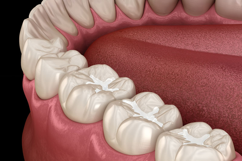 Should I Get Treated With Tooth Sealant?