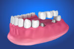 3d image of a dental implant bridge and a prosthesis jaw with a blue backdrop.