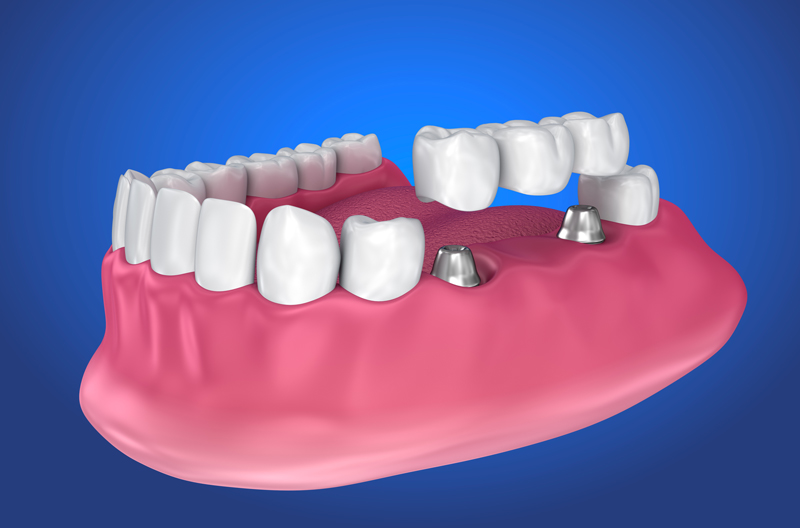 Am I A Candidate For Implant Supported Dentures?