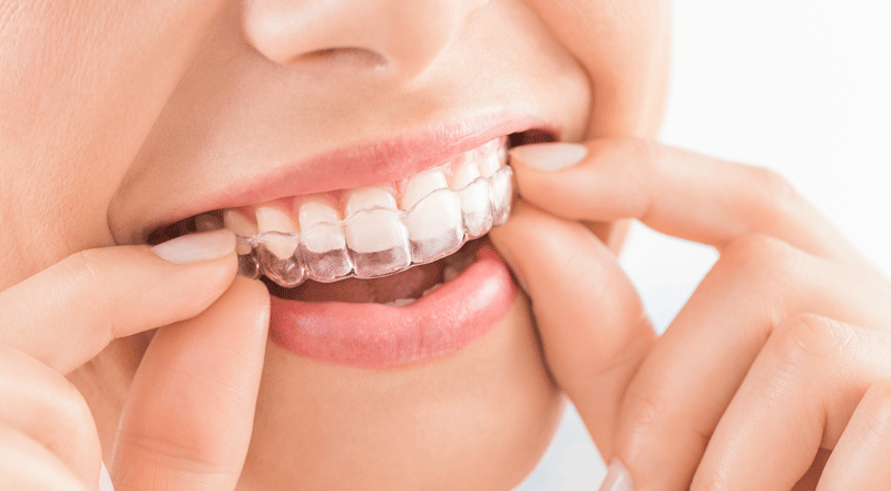 Will My Teeth Be Prepared For A Tooth Crown Procedure?