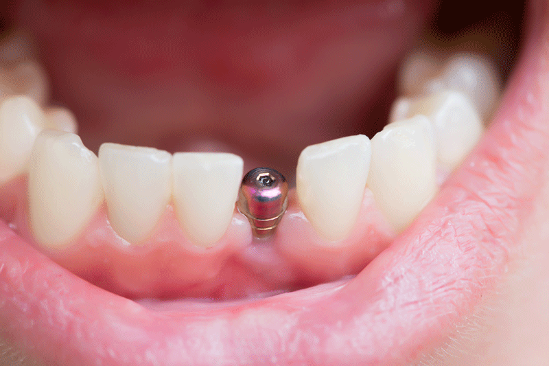 patient’s mouth with a single implant