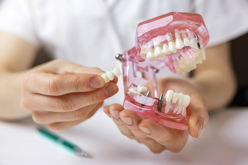dental bridge implant technology on human tooth jaw model